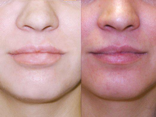 Hvordan man reducerer læberne?