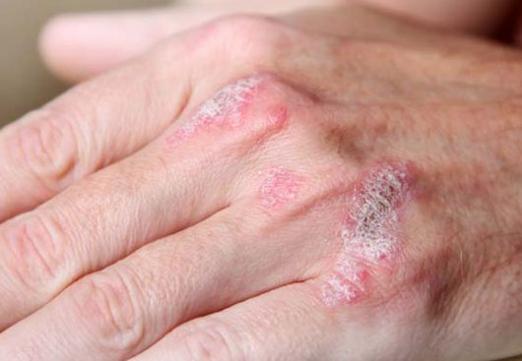 Sådan helbrede psoriasis?